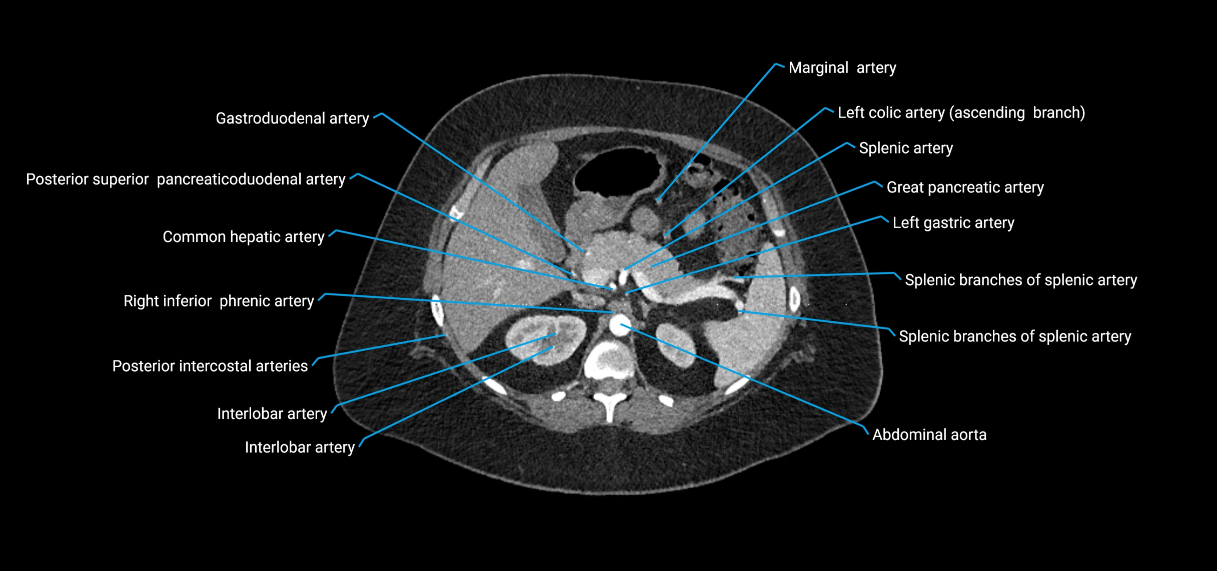 CTA abdomen axial cross sectional anatomy labelled image_52 (2).webp
